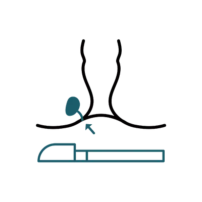 Anal Fistula Surgery