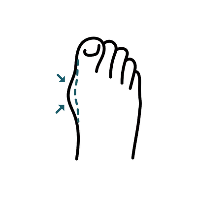 Bunion Surgery in Thailand: Cost, Top Surgeons & Hospitals