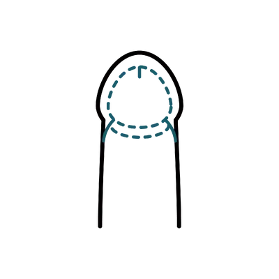 Circumcision in Thailand: Cost, Top Surgeons & Hospitals