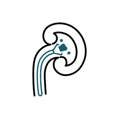 Kidney Stone Removal in Thailand: Cost, Top Surgeons & Hospitals