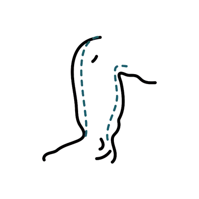 Lymphoedema Surgery in Thailand: Cost, Top Surgeons & Hospitals