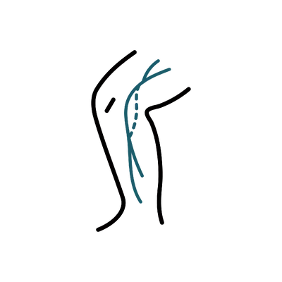 Peripheral Artery Bypass