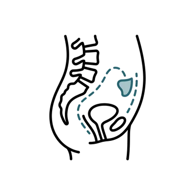 Peritoneal Vaginoplasty in Thailand