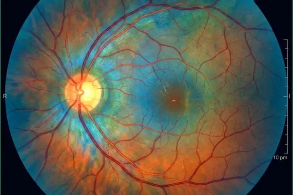 Retina & Vitreous