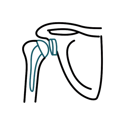 Shoulder Replacement