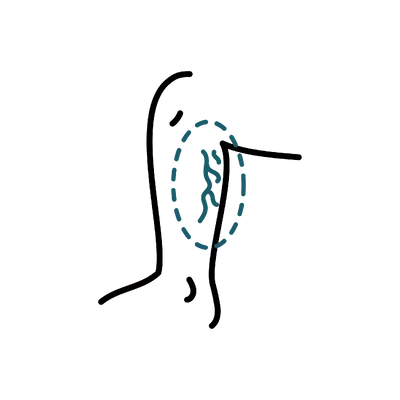 Varicose Vein Treatment